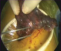 a) b) c) d) e) f) FIGURE 1 Segmentectomy performed using video-assisted thoracic surgery.