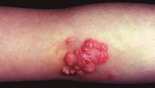 weeks. Lesions generally persist for several months and then resolve spontaneously, but many experience a subsequent recurrence.