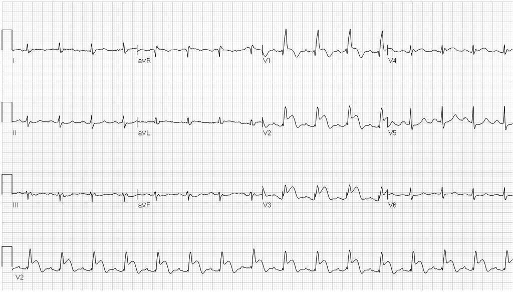 52 year old woman with sudden shortness of breath.