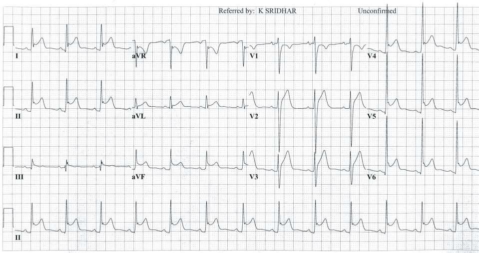 22 yo healthy young man, recent URTI, now having chest pain 1.