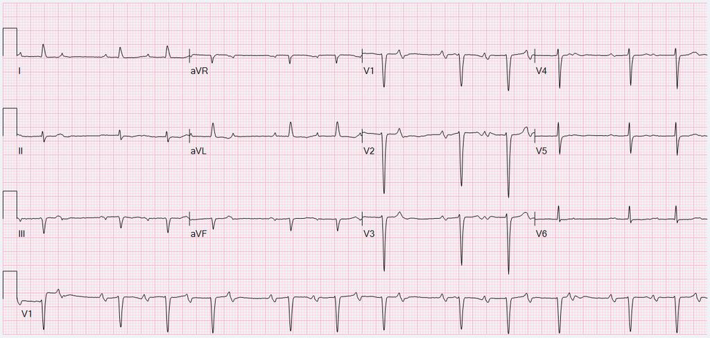 62 year old man, referred by sleep clinic for rhythm assessment.