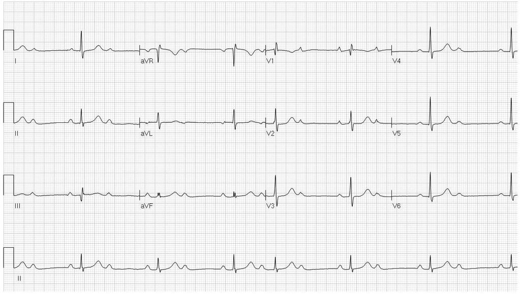 The conduction disturbance is most likely 1.In the sinus node 2.