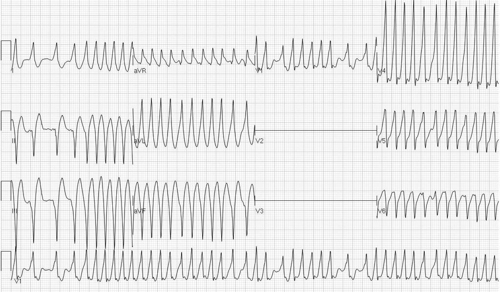 1/2 30 yo woman, stable with palpitations. Initial tx: 1.