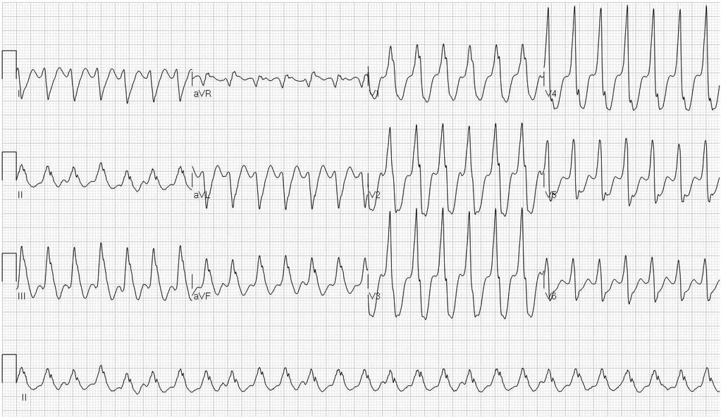 68 yo man, stable with palpitations. Most likely: 1. VT 2.