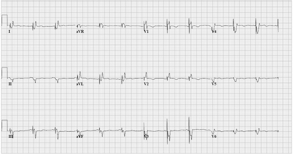 This pacemaker has: 1. One lead 2.