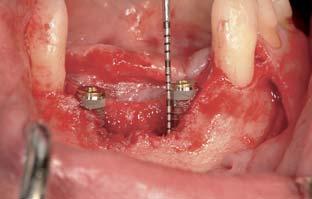 barrier is placed over the graft and fixed with miniscrews; (f) photograph obtained just before the abutment connection; (g) tissue after barrier removal, with the newly regenerated