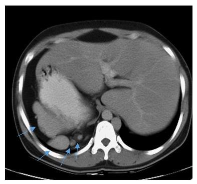 Figure 3: Axial CECT Showing Multiple Foci of Spleen in