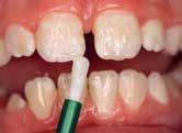 Fluoride content should be age-appropriate; in older patients higher levels of fluoride may be desirable.