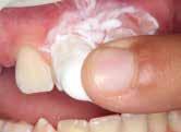 Tooth Mousse is recommended below the age of 6 to avoid the risk of fluorosis and in cases where extra fluoride supplementation is not needed