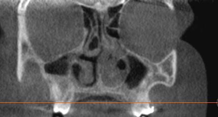 Deviated nasal septum-coronal view Central sagittal sections