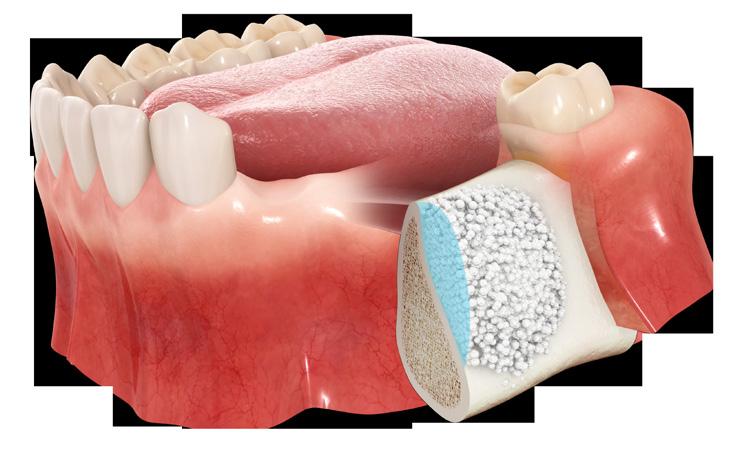 With today s high quality products, technology and proven techniques, bone graft surgery is safe, effective and in many