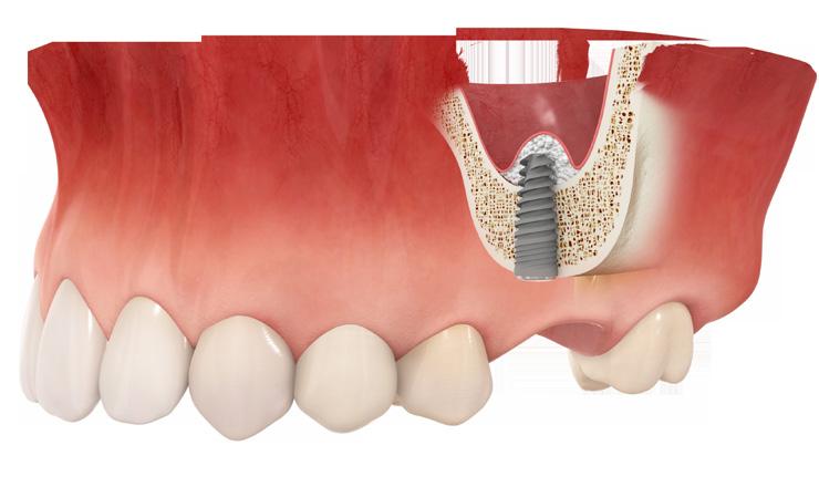 Ridge Augmentation Patients with insufficient bone mass for dental implant placement need the Ridge Augmentation Procedure.