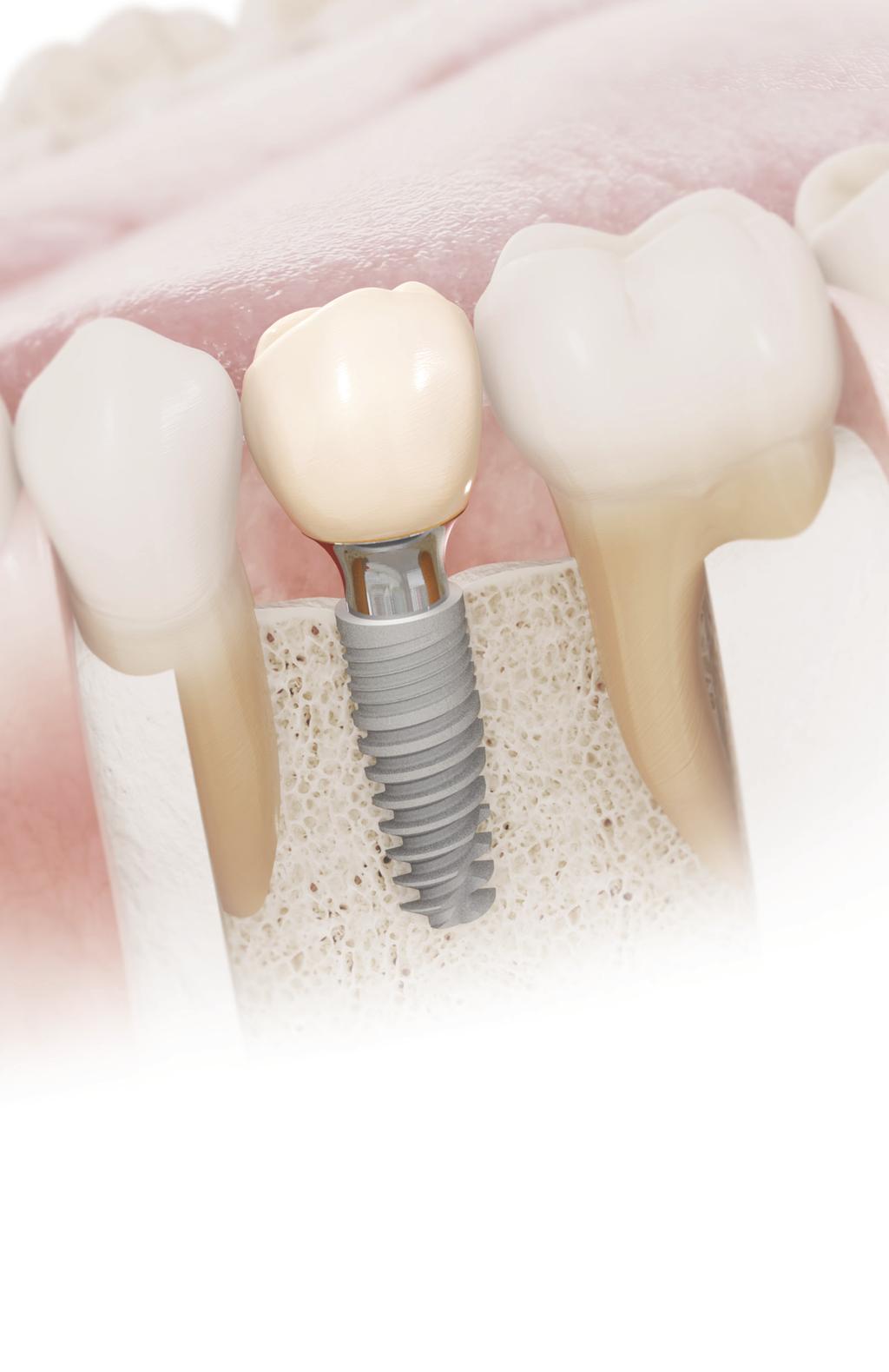 What is Dental Implants? Dental Prosthesis The final restoration (crown, bridge or denture) supported by the dental implants.