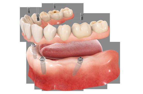 the denture. Are Dental Implants Right for You?