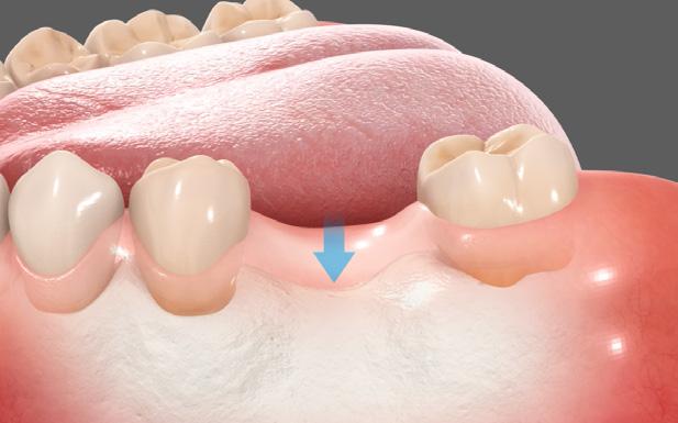 Changes After the Tooth Loss Absence of tooth or dental implant to stimulate and maintain the bone will lead to an