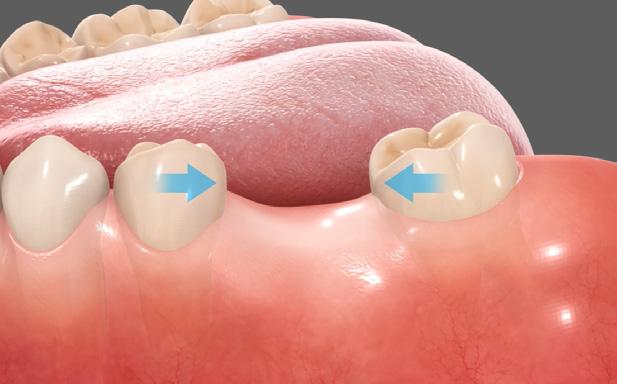 The adjacent teeth will shift laterally towards the vacant space and will affect the spacing in the other parts of