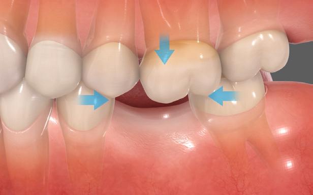 Since there is no counteracting force the opposing tooth will gradually shift vertically toward the vacant space.