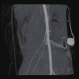 Dynamic CT angiography confirms the presence of a high-fl ow vascular malformation lateral to the knee joint.