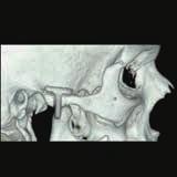 She now complains of persistent pain and abnormal Temporo-Mandibular Joint motion. Dynamic intermittent scanning at 1.
