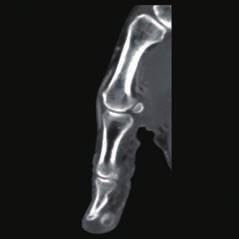 CASE 4 Para-osteal Mass This 65-year-old woman presented with a partially calcified mass of the thumb pad that first