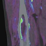 Scanning was performed for 105 seconds to capture the pre-contrast, arterial,