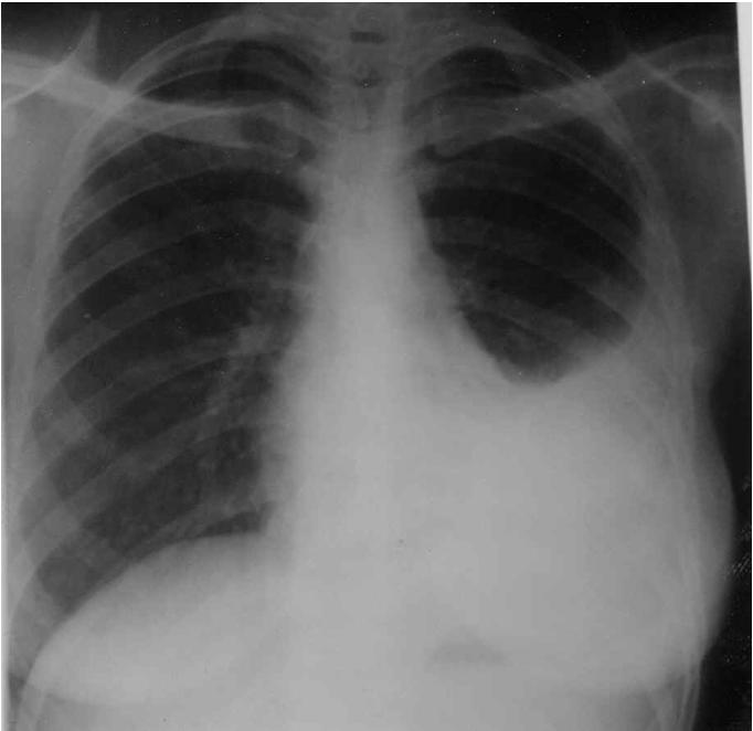 Primary Tuberculosis Pleural Effusion: Seen in up to 25% of those with primary TB.