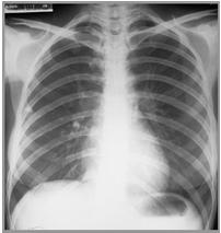 Clinical Evaluation: CXR Obtain a CXR in Every person with a newly positive TST or IGRA Any person at risk of TB who has symptoms and no