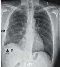 infected Immunosuppressed Differentiating Between TB Infection and Disease when the CXR is abnormal Abnormal CXR findings which could be