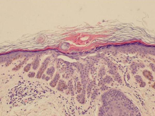 Histopathology Digitiform elongation of the rete ridges Basal