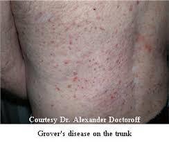 acantholytic dermatosis of unknown cause -