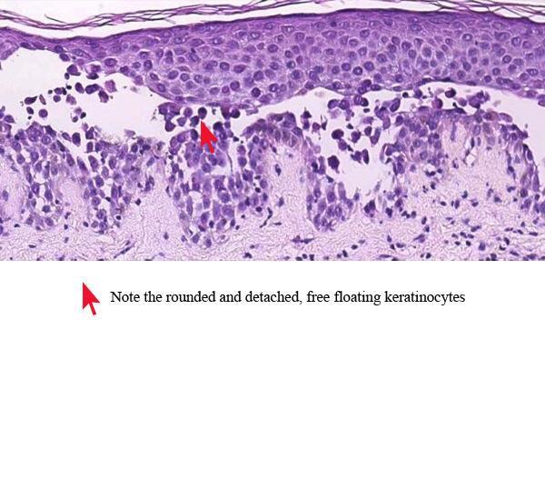 Acantholysis Loss of connection between epidermal