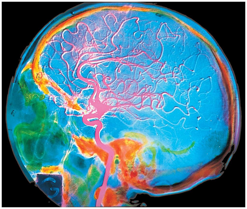 Methods of Visualizing the Living Human Brain: Structure Cerebral angiography