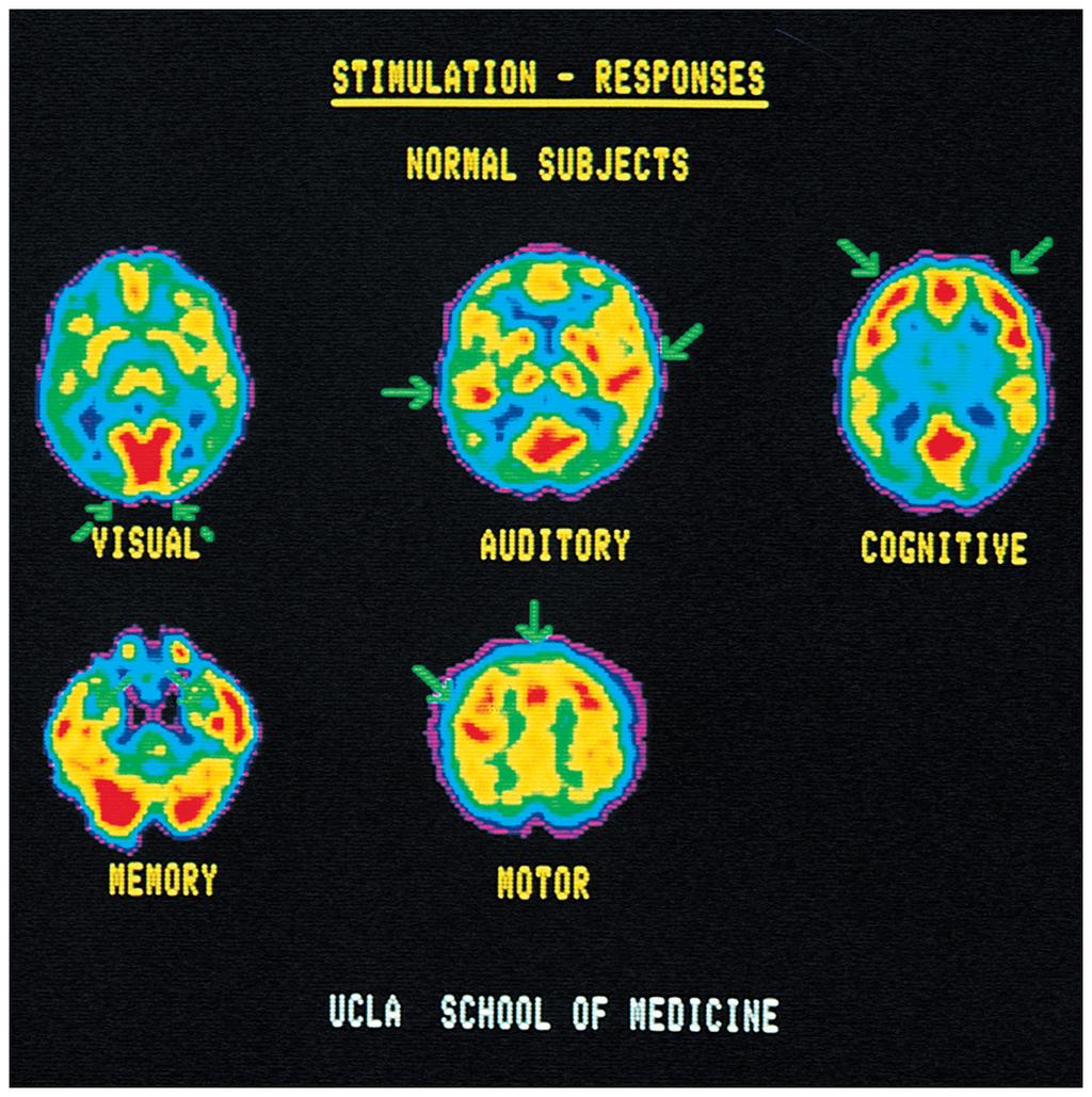 Methods of Visualizing the Living Human Brain: Function Positron emission tomography (PET) Positron