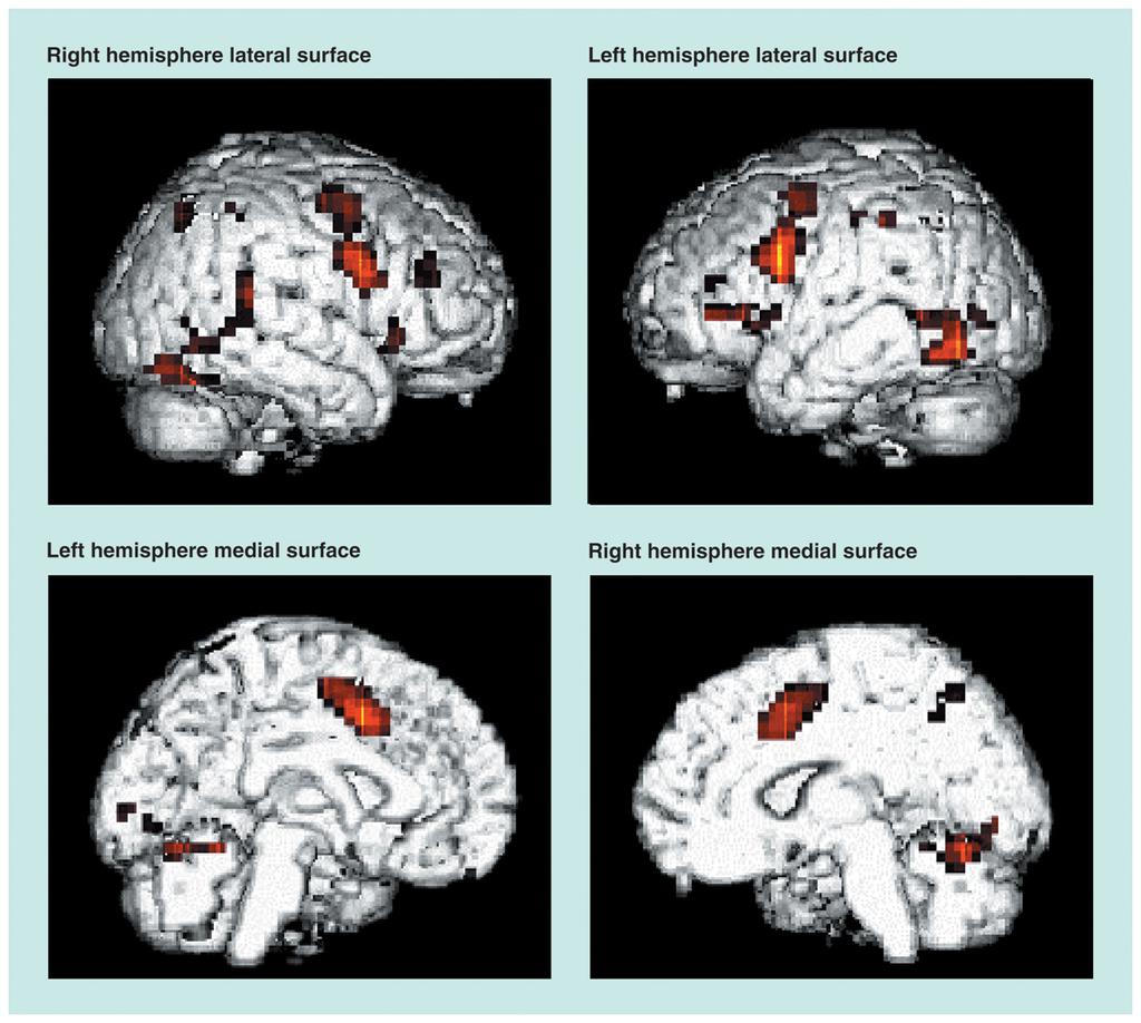 Functional MRI (fmri): BOLD fmris