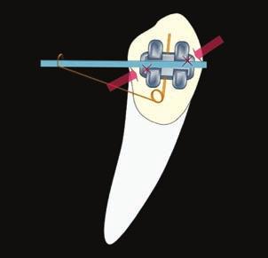 5 The crown of the tooth is tipped until the opposite internal angles of the bracket slot contact the archwire, creating a binding effect (Fig. 2).