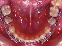 Uses of the Vertical Slot in Orthodontic rackets Fig.