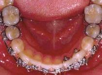 . Symmetrical mandibular molar protraction with uprighting springs.