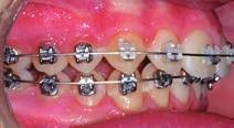 Interarch elastics and uprighting springs can be a useful combination in a case
