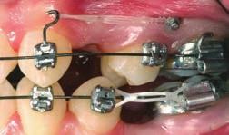 8 ddition of individual hooks and pins to V- slots helps keep patient from orienting elastics in wrong configuration.