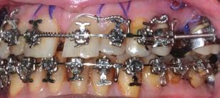 Cozzani, Mazzotta, owman, and Rinchuse Fig. 10 Power pins and Kobayashi ligatures inserted in V-slots substitute for soldered or crimpable hooks in surgical-orthodontic patient. final intercuspation.