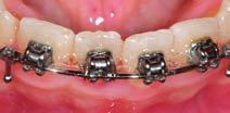 In that situation, the clinician is often required to return to undersize or more elastic wires to gather up the displaced second molars, with a consequent loss of threedimensional control