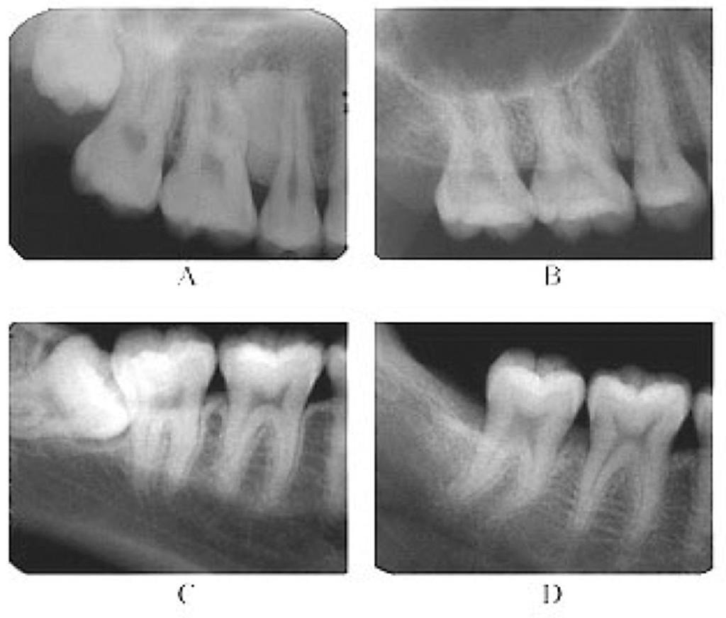 47 CM Dent J Vol. 32 No. 2 July-December 2011 The third molars are the teeth that are most often congenitally missing. If present, they might follow an abortive eruption path and become impacted.