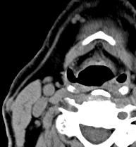 4D-CT Parathyroid adenoma vs lymph node
