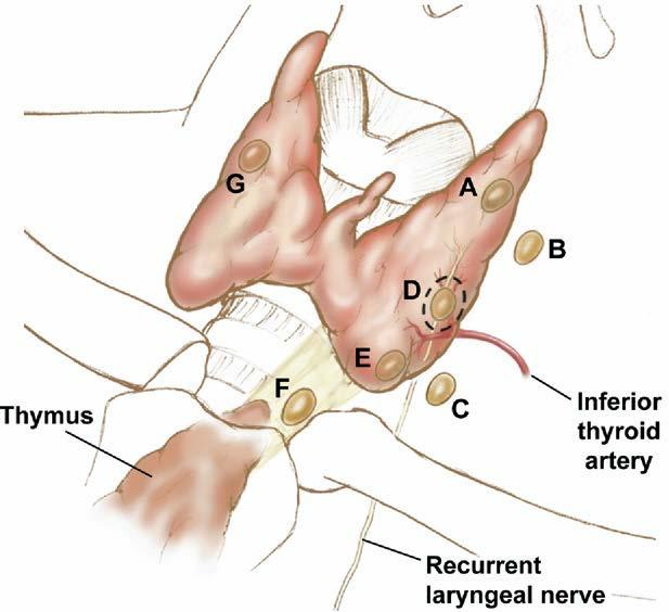 MDACC Nomenclature to organize and classify parathyroid adenomas Uniform and reliable description exact location of abnormal parathyroid glands Improves communication