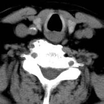 Imaging with 4D-CT Case 2- Type B T B- Ectopic Superior Gland Fallen posteriorly into tracheoesphageal
