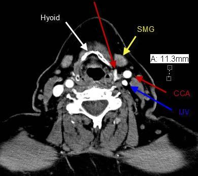 Intraoperative Ultrasound localization Case 1: Ectopic parapharyngeal parathyroid adenoma IJV CCA Axial 4DCT with arterially enhancing parathyroid adenoma