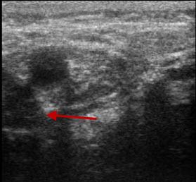 Transverse IOUS with Doppler demonstrates the adenoma and relationship to