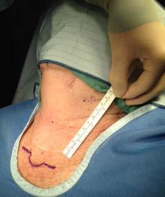 Intraoperative photographs The site of skin