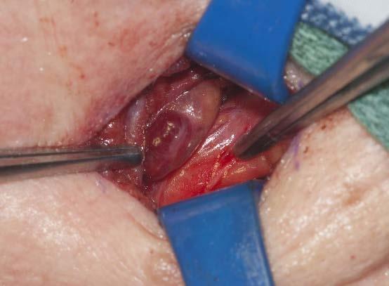 the previous incision Offending parathyroid