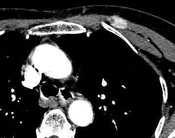 Intraoperative Ultrasound localization Case 2: Multiple parathyroid